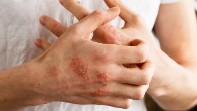 El Hospital San Bernardo convoca a personas con psoriasis a sumarse a un estudio sobre una innovadora terapia. Imagen ilustrativa