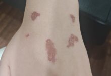 Las quemaduras de la menor tras el uso de glitter.
