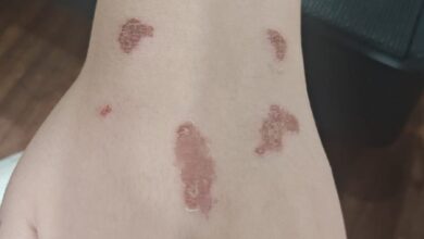 Las quemaduras de la menor tras el uso de glitter.